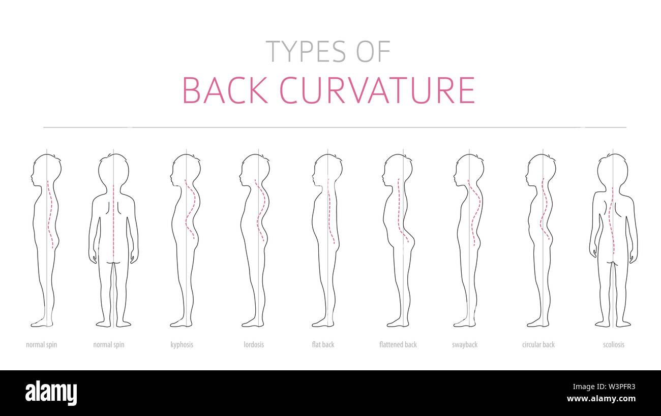 Types of kid`s back curvature. Medical disease infographic. Outline